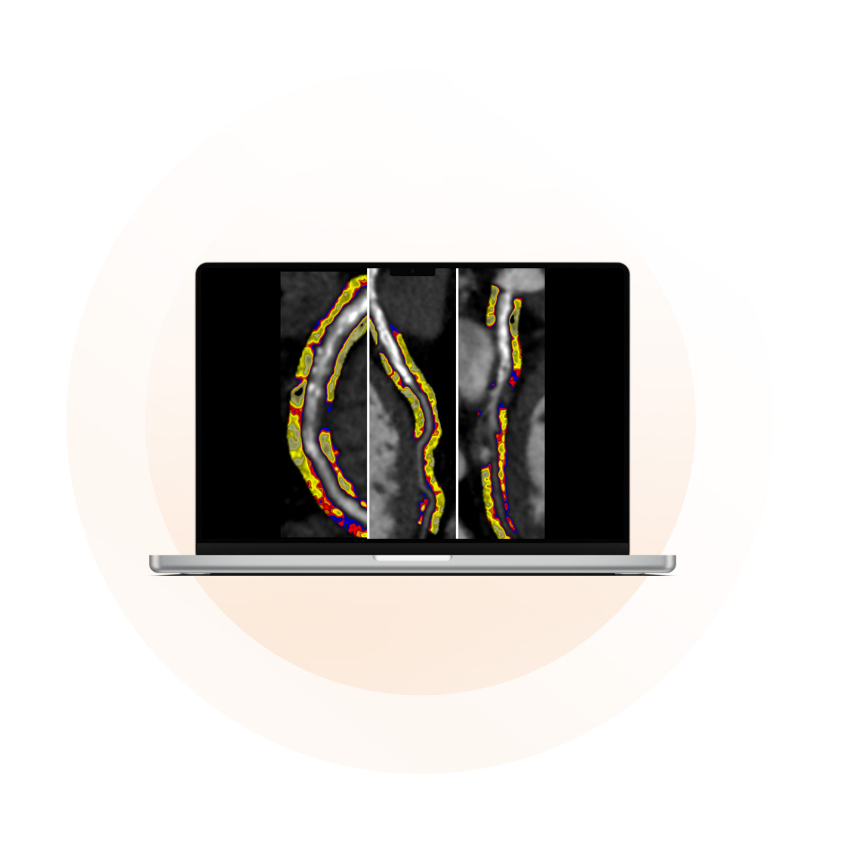 Patient Brochure for CaRi-Heart analysis